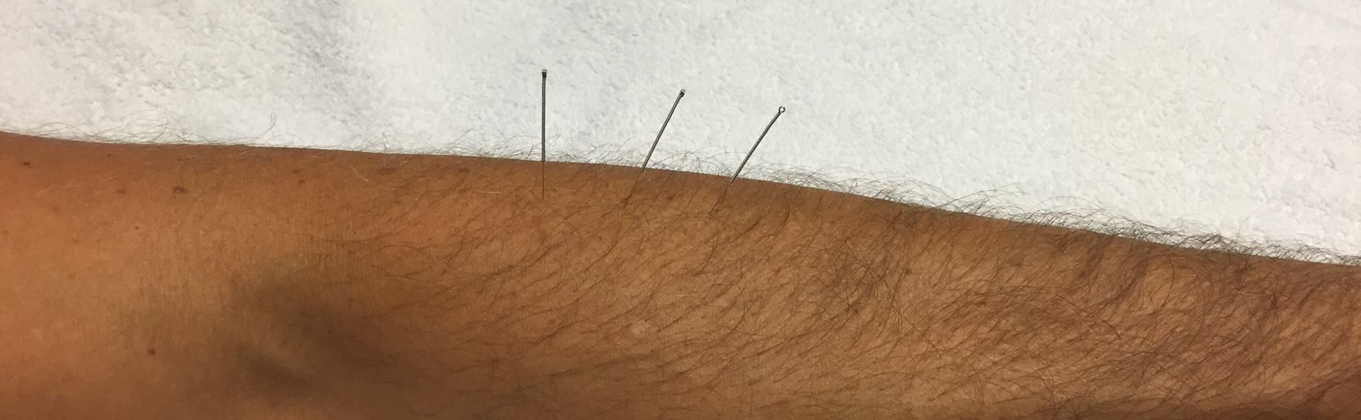 Dry Needling
